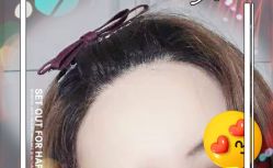 -大麦微针植发全国连锁