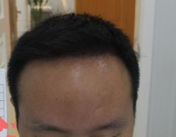 -大麦微针植发丨全国连锁