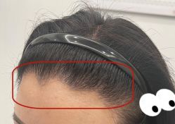 -大麦微针植发全国连锁