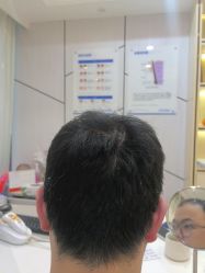 -碧莲盛·不剃发植发