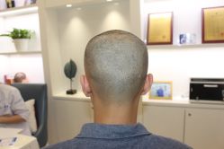 -大麦微针植发丨全国连锁