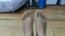 android_upload_pic-EPAI·灰指甲·甲沟炎·嵌甲护理