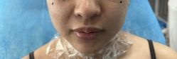 体验前-美安心医美·美迪迈黄金微针·美拉美医疗美容