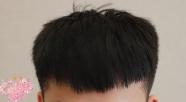 -大麦微针植发丨全国连锁