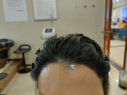 -碧莲盛·不剃发植发