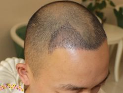 -大麦微针植发丨全国连锁