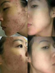 -瑶芳清颜草本祛痘