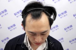 -大麦微针植发丨全国连锁