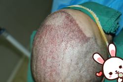 -大麦微针植发丨全国连锁