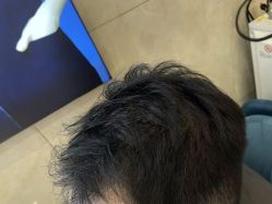 -碧莲盛·不剃发植发