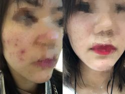 -成都苗方清颜专业祛痘