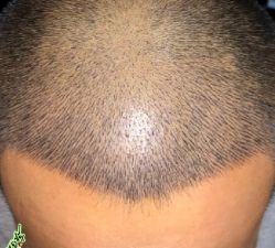 -大麦微针植发丨全国连锁