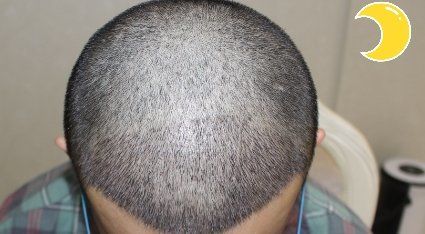 -大麦微针植发丨全国连锁