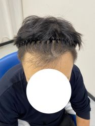 -大麦微针植发全国连锁