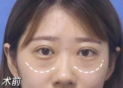 -天津健丽·去眼袋医疗美容机构