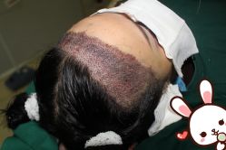 点击看大图 -大麦微针植发丨全国连锁