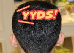 -大麦微针植发丨全国连锁