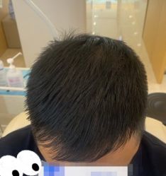 -大麦微针植发丨全国连锁