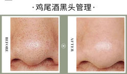-清颜堂丨分子祛痘·功效美肤