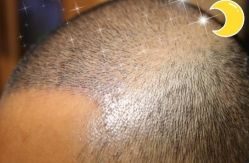 -大麦微针植发丨全国连锁