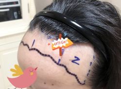 -大麦微针植发全国连锁