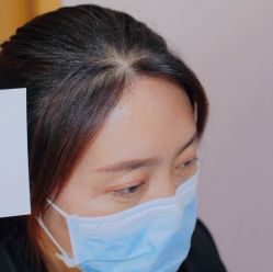 点击看大图 体验后-大麦微针植发全国连锁