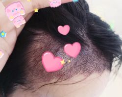 -大麦微针植发全国连锁