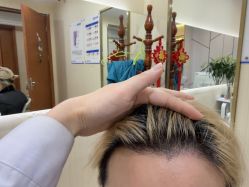 -碧莲盛·不剃发植发