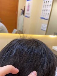 -碧莲盛·不剃发植发