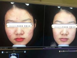 -苑苑vbeauty科技美容SPA
