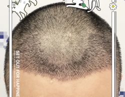 -大麦微针植发全国连锁