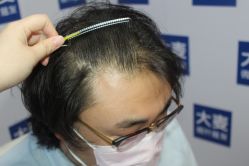 -大麦微针植发丨全国连锁