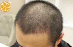 -大麦微针植发丨全国连锁