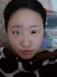 -苗方清颜专业祛痘