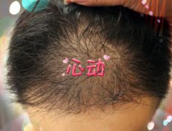 -大麦微针植发全国连锁