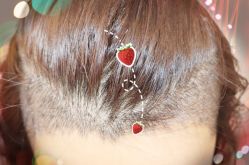 -大麦微针植发全国连锁