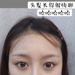-碧莲盛·不剃发植发