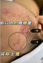 -瑶芳清颜草本祛痘