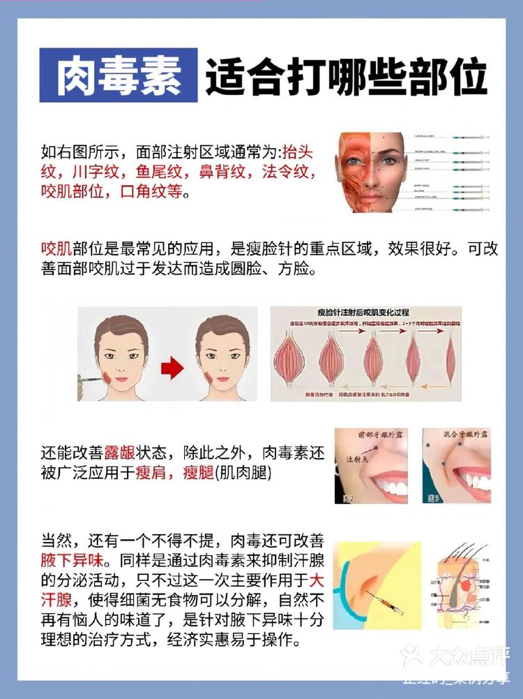 肉毒收紧下颌缘示意图图片