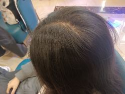 -碧莲盛·不剃发植发