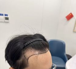 -大麦微针植发全国连锁