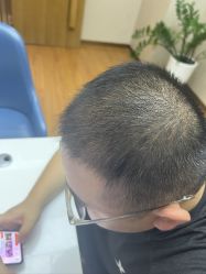 体验后-大麦微针植发全国连锁