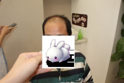 -大麦微针植发丨全国连锁