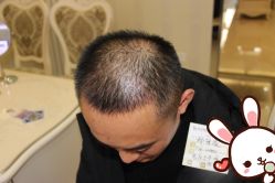 点击看大图 -大麦微针植发丨全国连锁