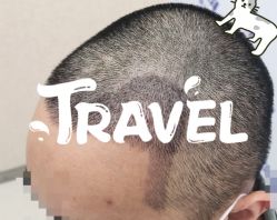 -大麦微针植发全国连锁