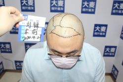 -大麦微针植发丨全国连锁