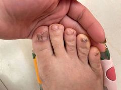 -世龙世家灰指甲鸡眼脚气甲沟炎跖疣护理(通州店)