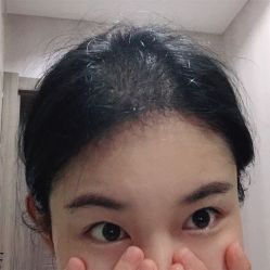 -碧莲盛·不剃发植发
