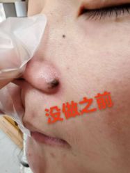 -北京美痣堂古方祛痣斑疣瘊