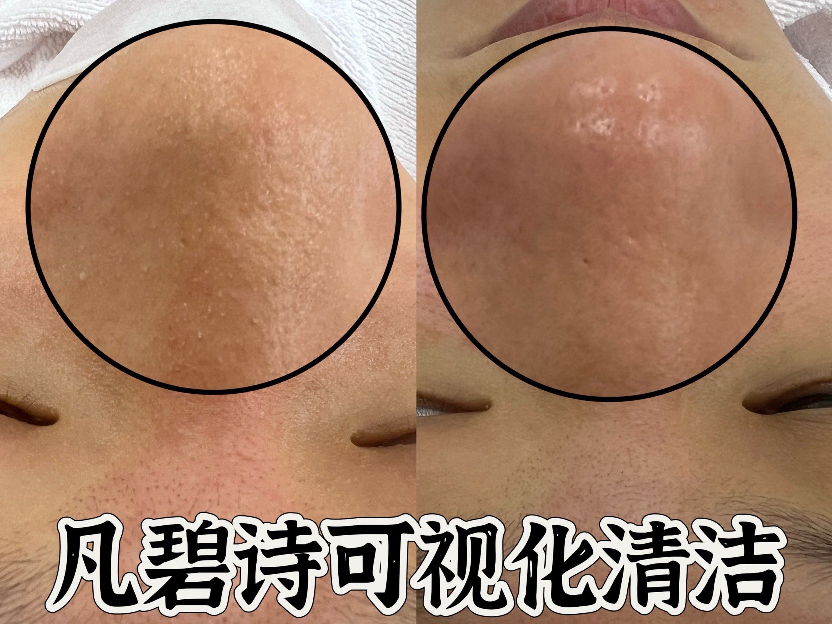 密密麻麻草莓鼻,毛孔粗大别着急
fb